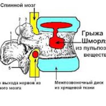 ГРЫЖА ШМОРЛЯ и ПРОФИЛАКТОР ЕВМИНОВА