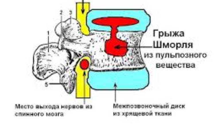 ГРЫЖА ШМОРЛЯ и ПРОФИЛАКТОР ЕВМИНОВА