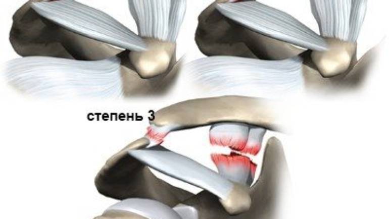 ПОЧЕМУ ПРОИСХОДИТ РАСТЯЖЕНИЕ СВЯЗОК ПЛЕЧЕВОГО СУСТАВА